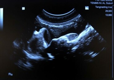 УЗИ щитовидной железы: что именно смотрят, как подготовиться и почему это не страшно