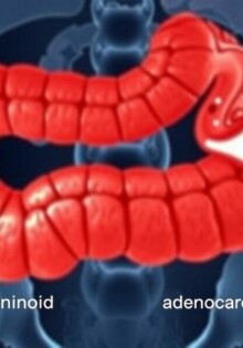 Tumore des Wurmfortsatzes: Karzinoid und Adenokarzinom — Una guía comprensible sobre los tumores del apéndice