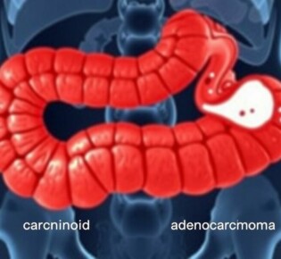 Tumore des Wurmfortsatzes: Karzinoid und Adenokarzinom — Una guía comprensible sobre los tumores del apéndice