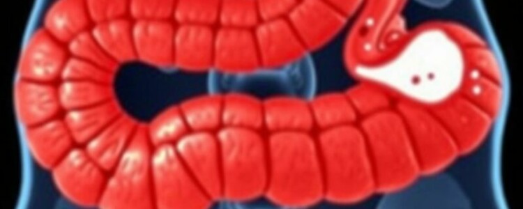 Tumore des Wurmfortsatzes: Karzinoid und Adenokarzinom — Una guía comprensible sobre los tumores del apéndice