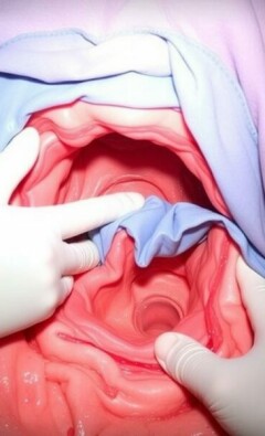 Drainage-Einlage nach Operation bei Perforation: qué significa para usted y cómo afrontarlo