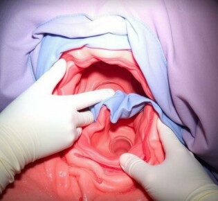 Drainage-Einlage nach Operation bei Perforation: qué significa para usted y cómo afrontarlo