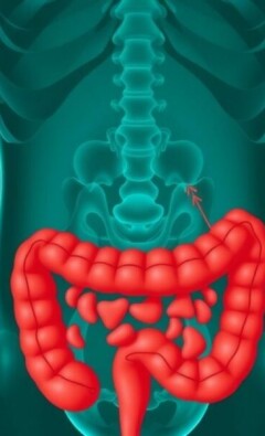 Die Geschichte der Appendizitis-Diagnose: un viaje desde la sospecha hasta la imagen