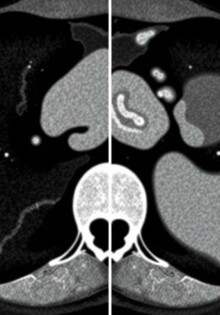 Inteligencia artificial y apendicitis: cómo las TC están cambiando el diagnóstico