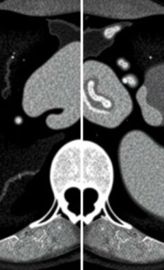 Inteligencia artificial y apendicitis: cómo las TC están cambiando el diagnóstico