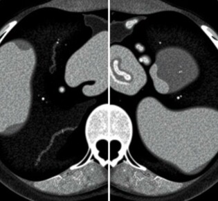 Inteligencia artificial y apendicitis: cómo las TC están cambiando el diagnóstico