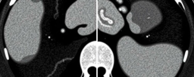 Inteligencia artificial y apendicitis: cómo las TC están cambiando el diagnóstico