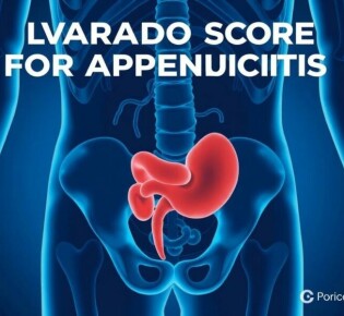 Understanding the Alvarado Score for Appendicitis: A Simple Tool with Big Impact