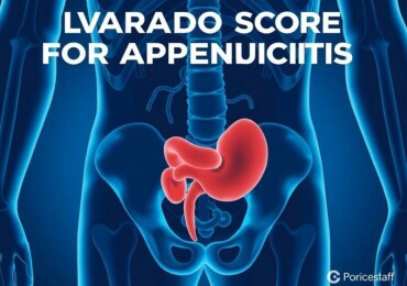 Understanding the Alvarado Score for Appendicitis: A Simple Tool with Big Impact