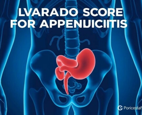 Understanding the Alvarado Score for Appendicitis: A Simple Tool with Big Impact