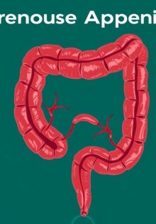 Apendicitis gangrenosa: riesgos y manejo — entender lo que está en juego y cómo actuar