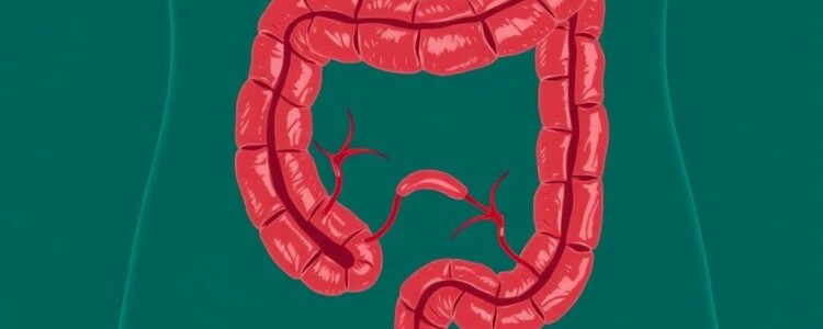 Apendicitis gangrenosa: riesgos y manejo — entender lo que está en juego y cómo actuar