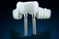 Зубные импланты Anthogyr: что важно знать перед выбором системы