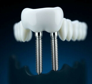 Зубные импланты Anthogyr: что важно знать перед выбором системы