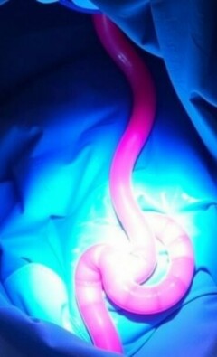 Postoperative Ileus nach Appendektomie: Ursachen, Symptome und Behandlungsmöglichkeiten