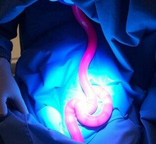 Postoperative Ileus nach Appendektomie: Ursachen, Symptome und Behandlungsmöglichkeiten