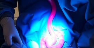 Postoperative Ileus nach Appendektomie: Ursachen, Symptome und Behandlungsmöglichkeiten