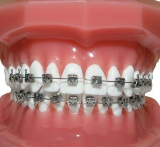 Понимаем стоимость брекетов: что входит в цену и как выбрать оптимальный вариант