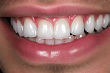 Исправление прикуса в стоматологии: как вернуть улыбку