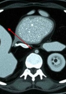 Radiology Corner: Cómo identificar la apendicitis en una tomografía computarizada