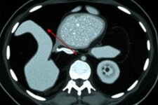 Radiology Corner: Cómo identificar la apendicitis en una tomografía computarizada