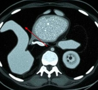 Radiology Corner: Cómo identificar la apendicitis en una tomografía computarizada