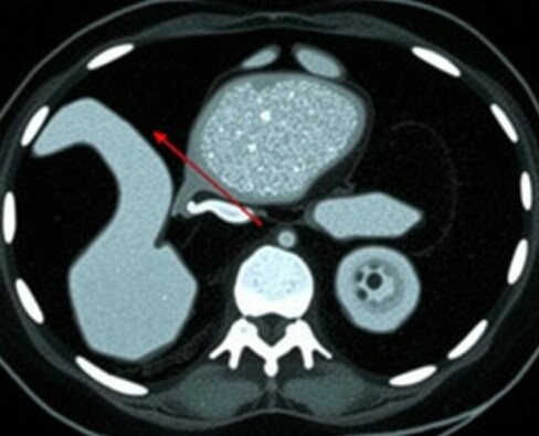 Radiology Corner: Cómo identificar la apendicitis en una tomografía computarizada
