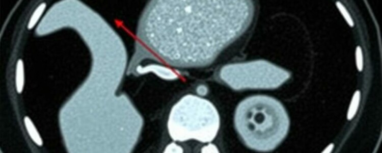 Radiology Corner: Cómo identificar la apendicitis en una tomografía computarizada