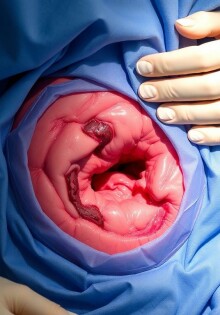 Wundheilungsstörungen nach Blinddarm-OP: Ursachen, Risiken und Behandlungsmöglichkeiten