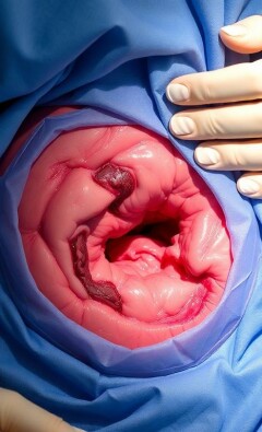 Wundheilungsstörungen nach Blinddarm-OP: Ursachen, Risiken und Behandlungsmöglichkeiten