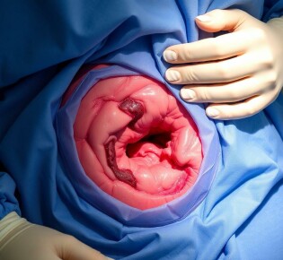 Wundheilungsstörungen nach Blinddarm-OP: Ursachen, Risiken und Behandlungsmöglichkeiten