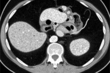 Radiology Corner: Cómo identificar la apendicitis en una tomografía computarizada
