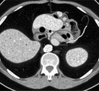 Radiology Corner: Cómo identificar la apendicitis en una tomografía computarizada