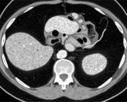 Radiology Corner: Cómo identificar la apendicitis en una tomografía computarizada