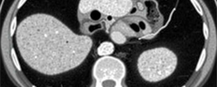 Radiology Corner: Cómo identificar la apendicitis en una tomografía computarizada