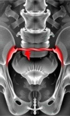 Understanding the Obturator Sign in Appendicitis: A Key Diagnostic Clue