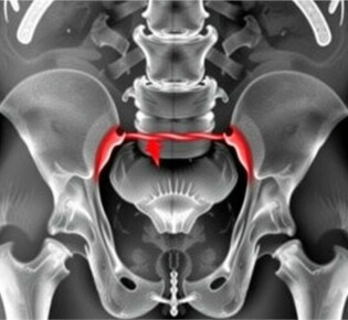 Understanding the Obturator Sign in Appendicitis: A Key Diagnostic Clue