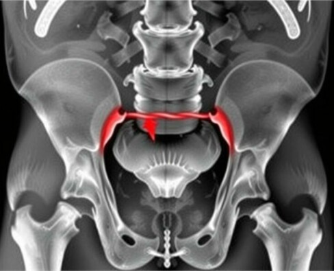 Understanding the Obturator Sign in Appendicitis: A Key Diagnostic Clue