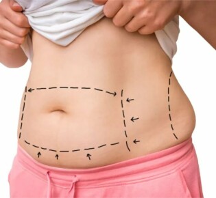 Выбор между резекцией и шунтированием желудка: Какая процедура подходит лучше для вас?