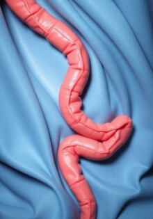 Adhäsionen nach Blinddarm-OP: Ursachen, Folgen und moderne Behandlungsmethoden