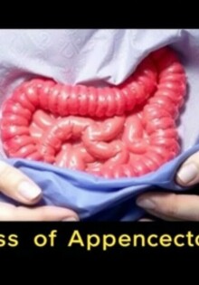Understanding the Risks of Appendectomy: What You Need to Know