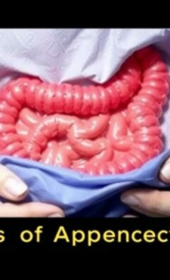 Understanding the Risks of Appendectomy: What You Need to Know