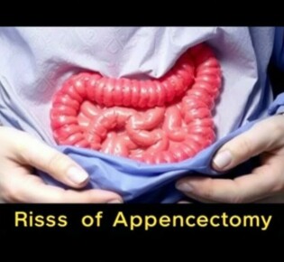 Understanding the Risks of Appendectomy: What You Need to Know