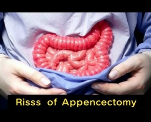 Understanding the Risks of Appendectomy: What You Need to Know