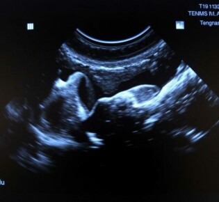 УЗИ щитовидной железы: что именно смотрят, как подготовиться и почему это не страшно