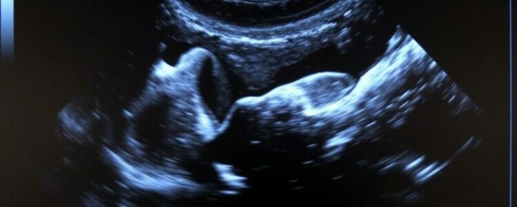 УЗИ щитовидной железы: что именно смотрят, как подготовиться и почему это не страшно