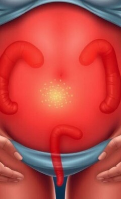 Appendicitis and Pregnancy: What Every Expectant Mother Needs to Know