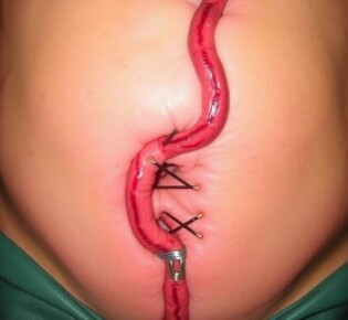 Nahtinsuffizienz an der Zäkumschlinge: cuando la sutura falla en la región cecal