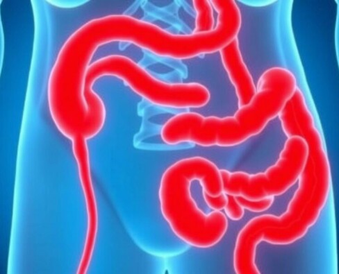 Apéndice y EII: desentrañando la sorprendente conexión entre la apendicitis y la enfermedad inflamatoria intestinal