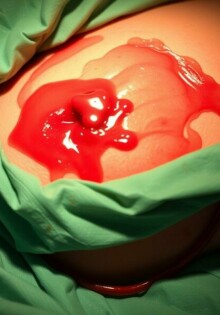 L’hémorragie postopératoire: cuando el silencio de la herida se rompe y cómo actuar con cabeza fría